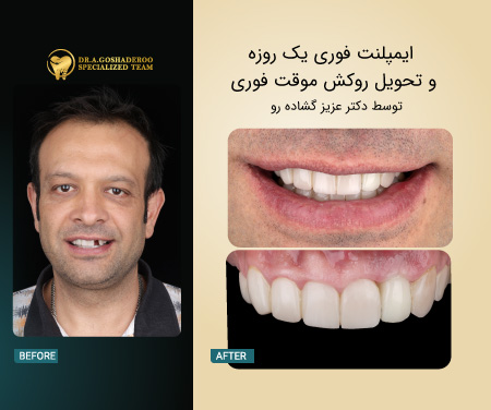 دندان موقت ثابت پس از بازسازی کامل فک با All-on-X